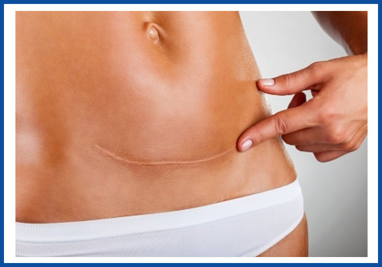 scar-removal-columbia-sc